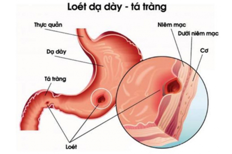 Biểu hiện bệnh viêm loét dạ dày - tá tràng